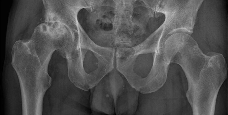 Arthrose de stade 3 de l'articulation de la hanche à la radiographie