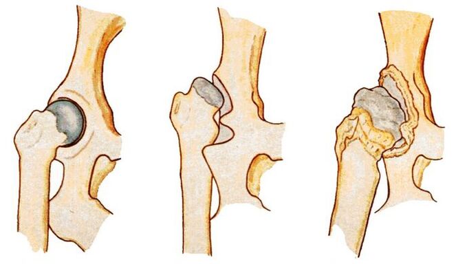 La dysplasie de la hanche est une cause de coxarthrose secondaire