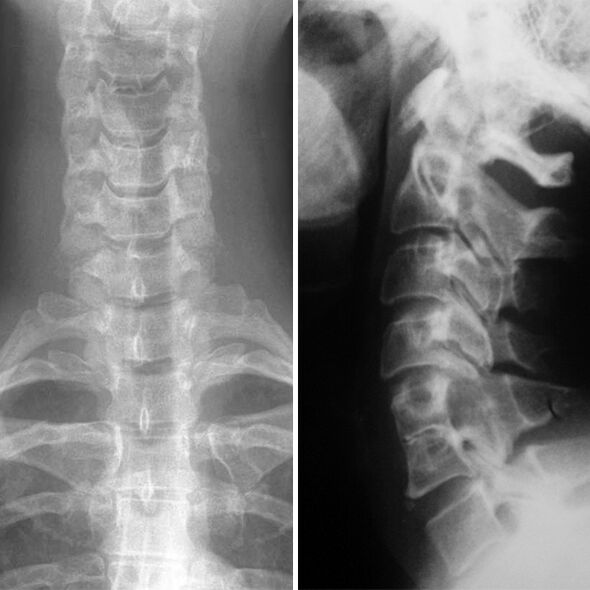 X-rayon de la colonne cervicale