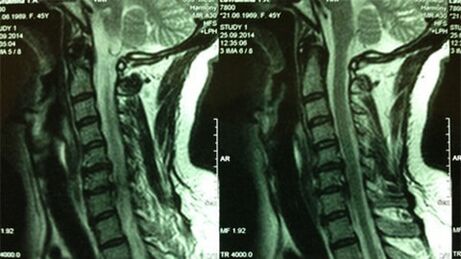 IRM du service cervical