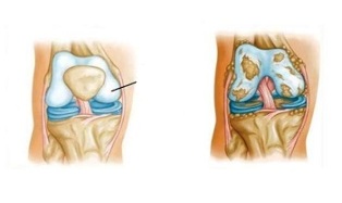 changements pathologiques dans l'arthrose du genou