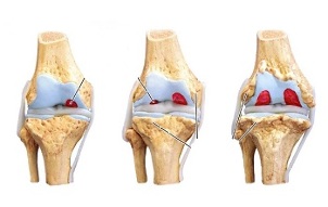 stades d'arthrose de l'articulation du genou