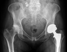 diagnostic d'arthrose de l'articulation de la hanche