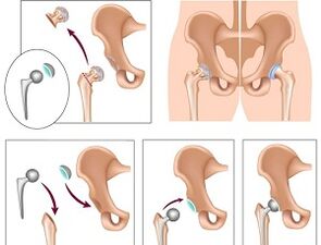 endoprothèses pour arthrose de l'articulation de la hanche