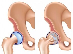 symptômes d'arthrose de l'articulation de la hanche