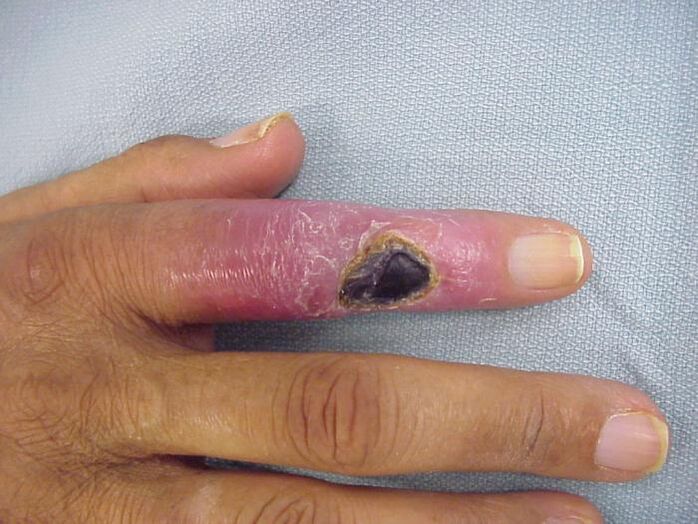 ostéomyélite comme cause de douleur dans les articulations des doigts