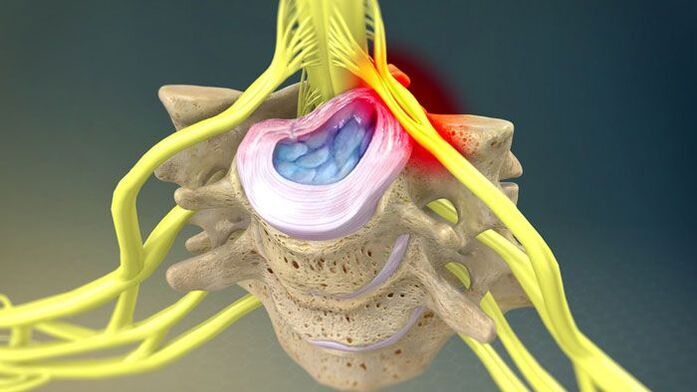 La protrusion du disque intervertébral est la cause de la douleur au cou